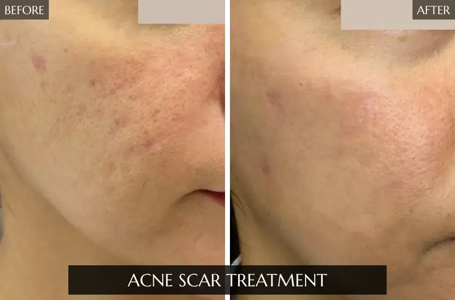 Acne-Scar-Treatment