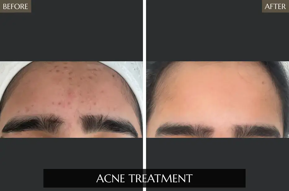 Acne-Treatment