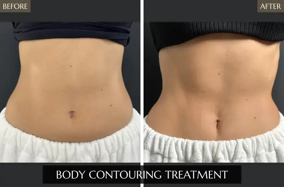 Body-Contouring-1
