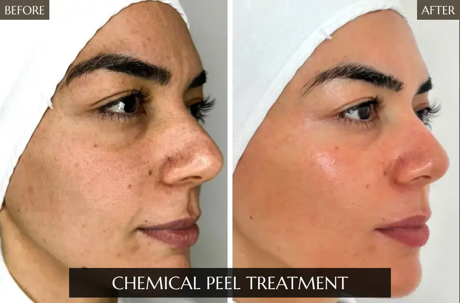 Chemical-Peel-Treatment