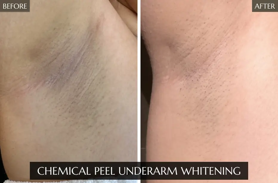 Chemical-Peel-Underarm-Whitening