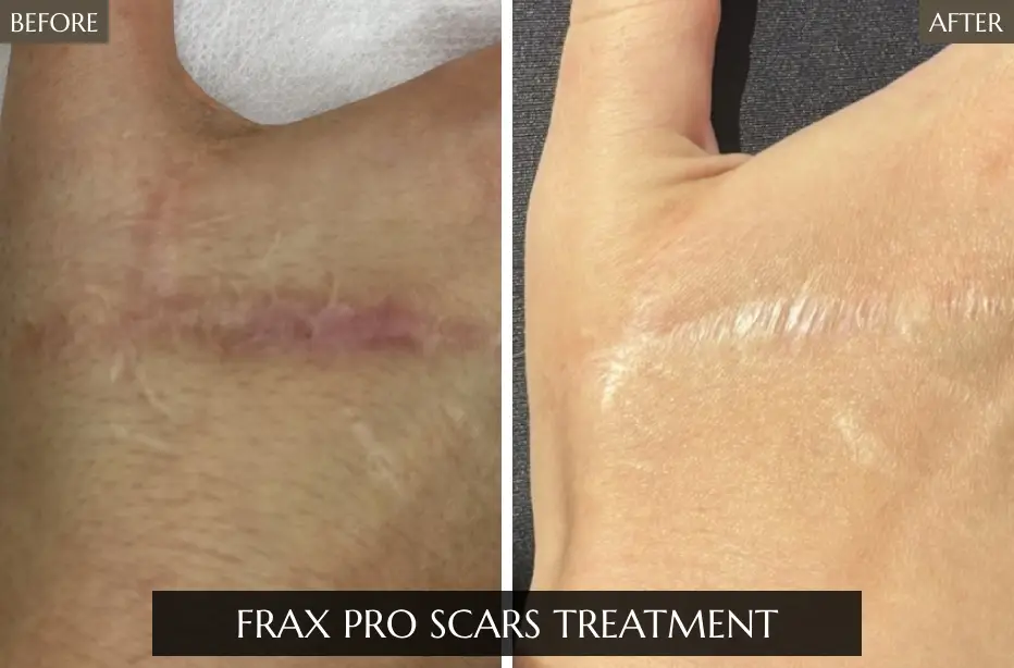 Frax-Pro-Scars-Treatment