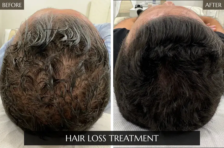 Hair-Loss-Treatment