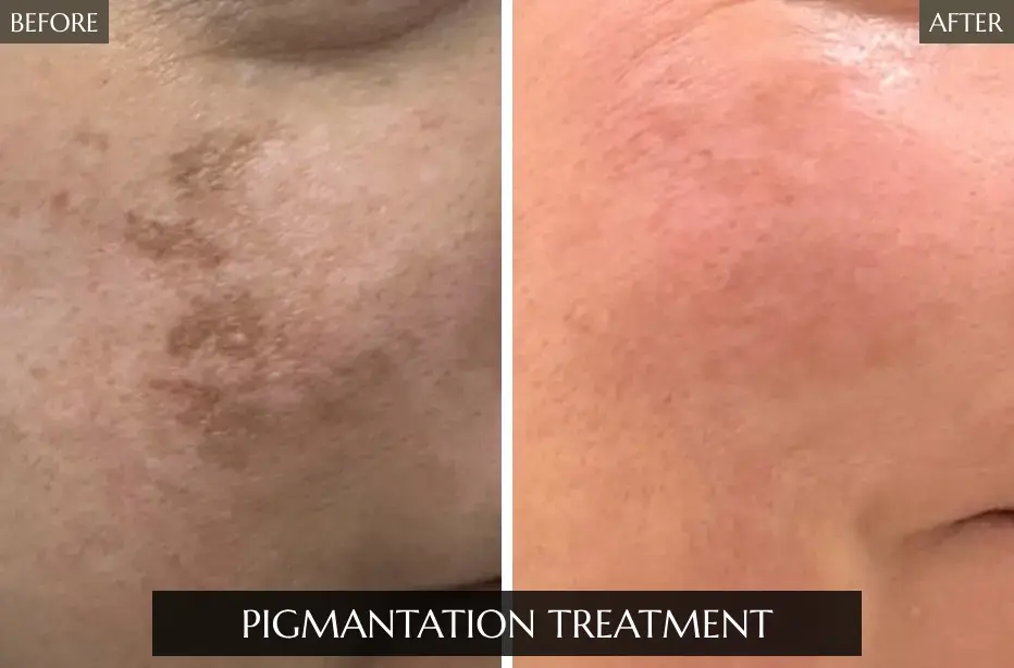 Pigmantation-Treatment