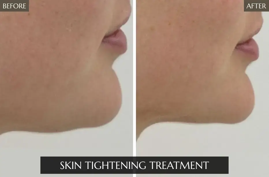 Skin-Tightening-Treatment