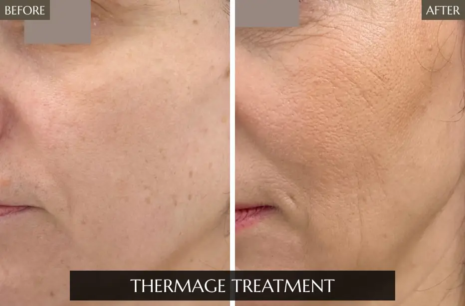 Thermage-Treatment