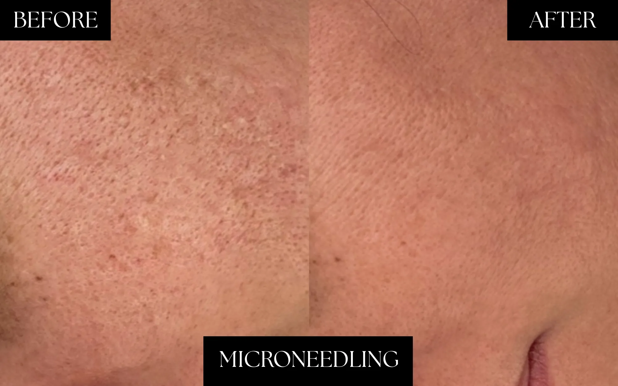 Microneedling