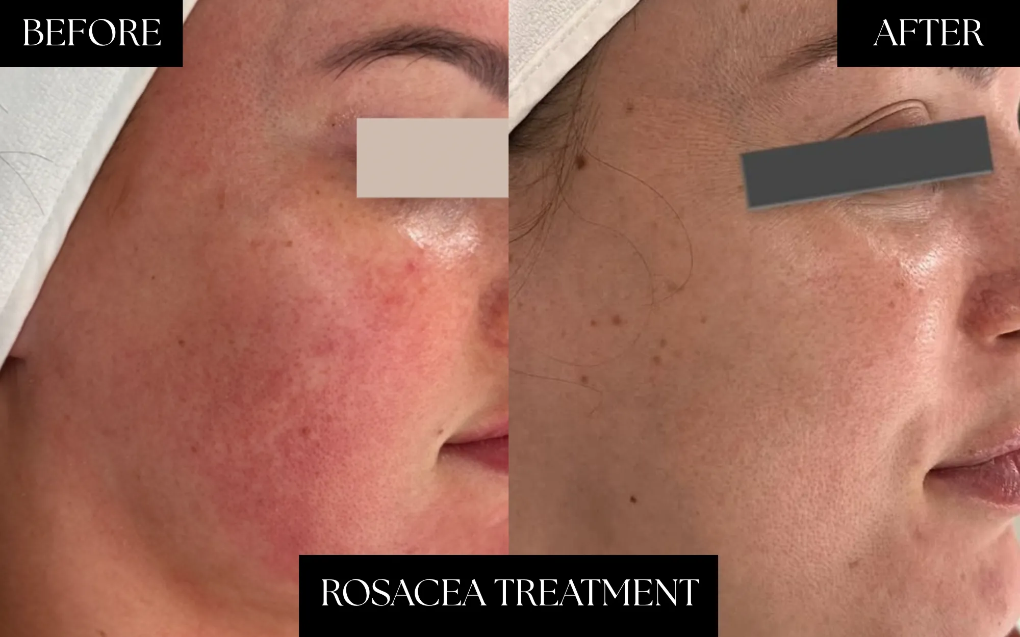 Rosacea Treatment