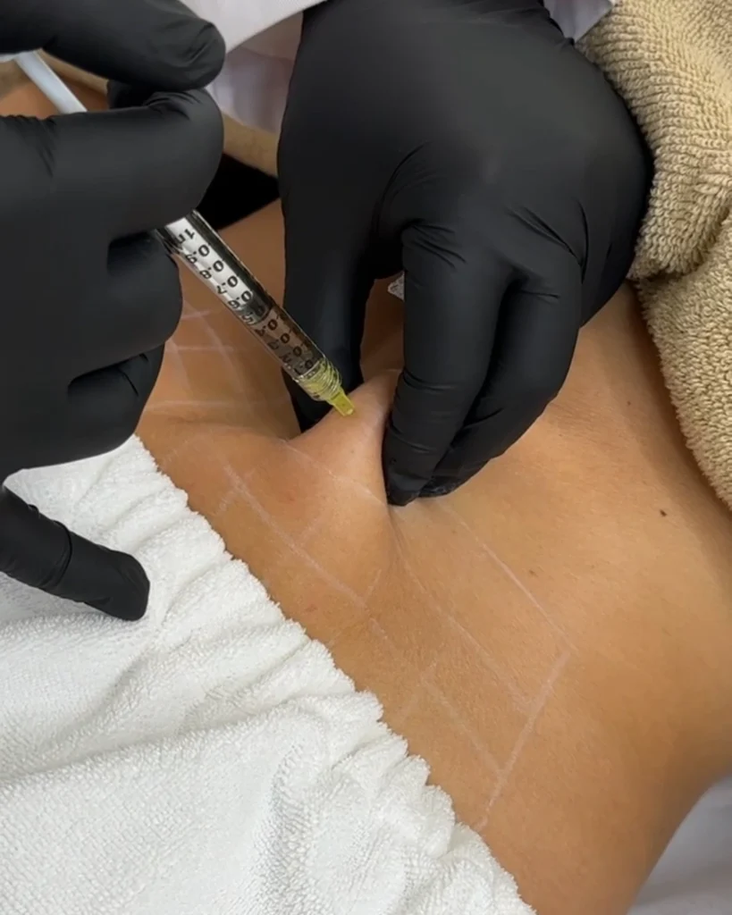 non surgical fat dissolving