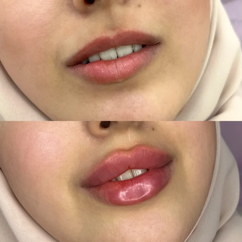 lip filler