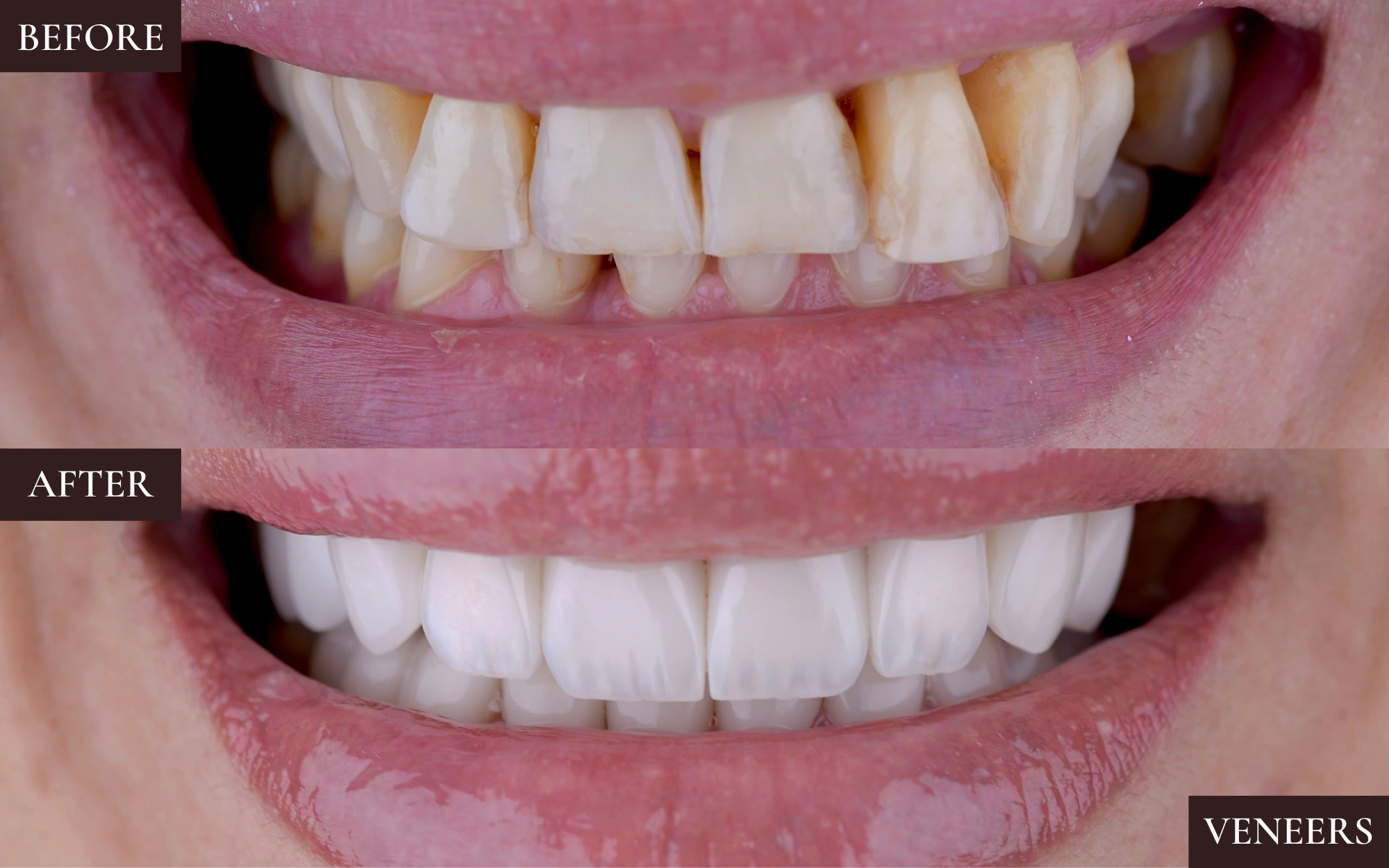 Veneers0