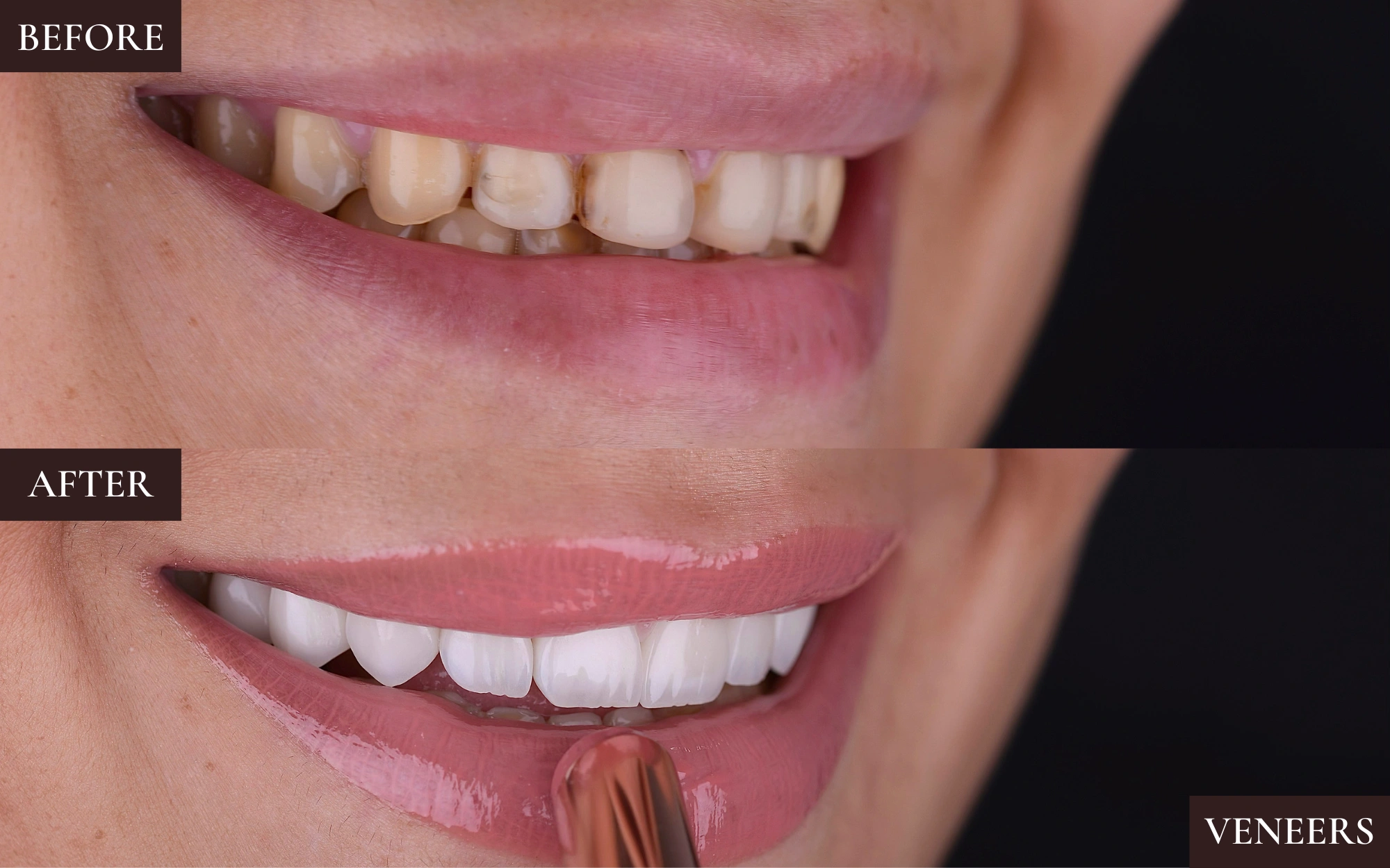 Veneers2