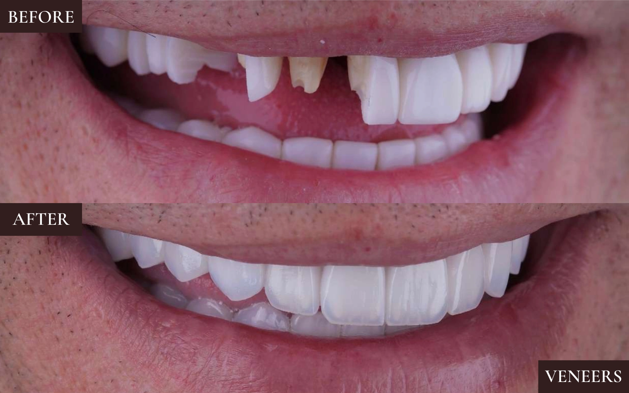Veneers3