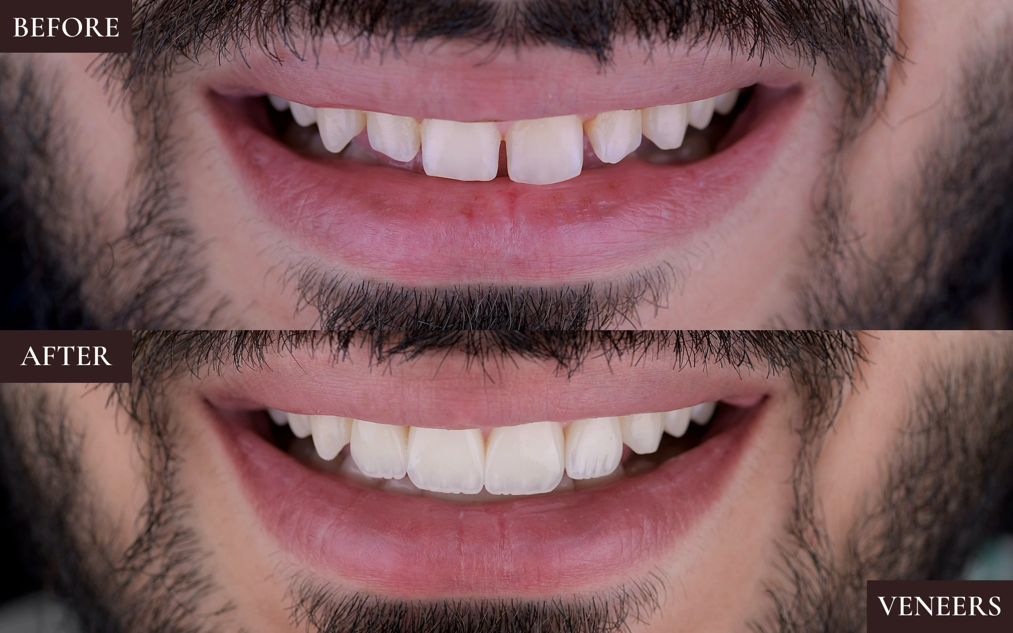 Veneers4