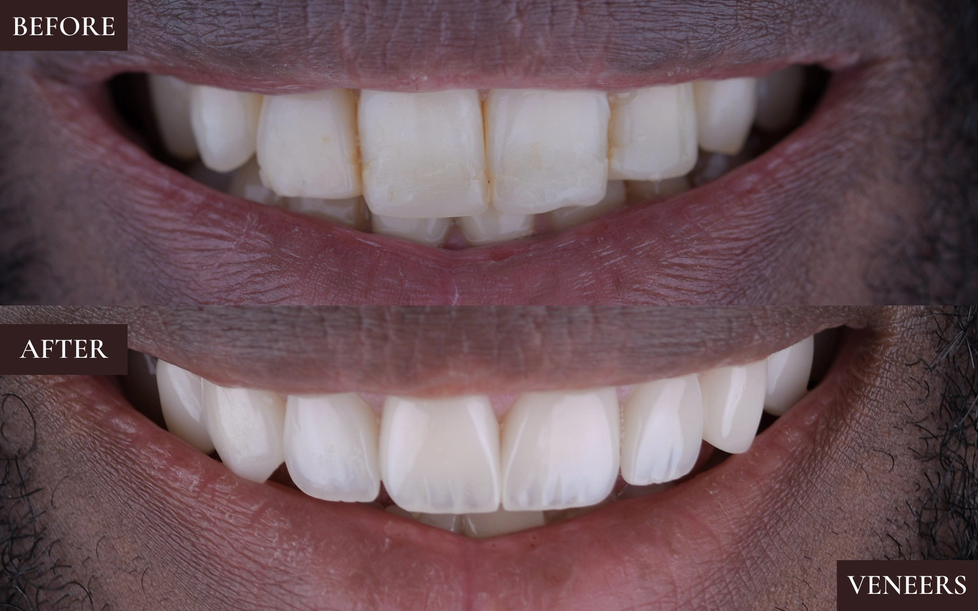 Veneers5