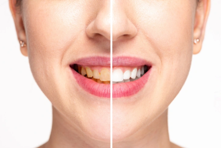 teeth whitening in Dubai