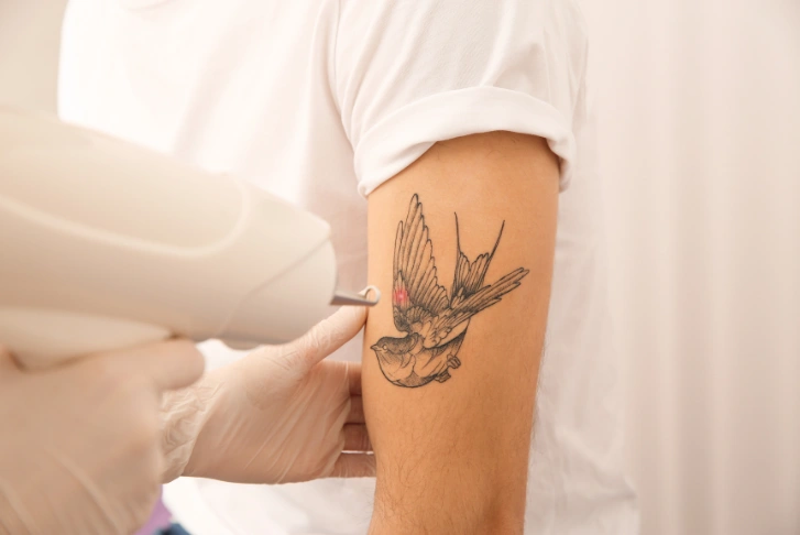 laser tattoo removal in Dubai