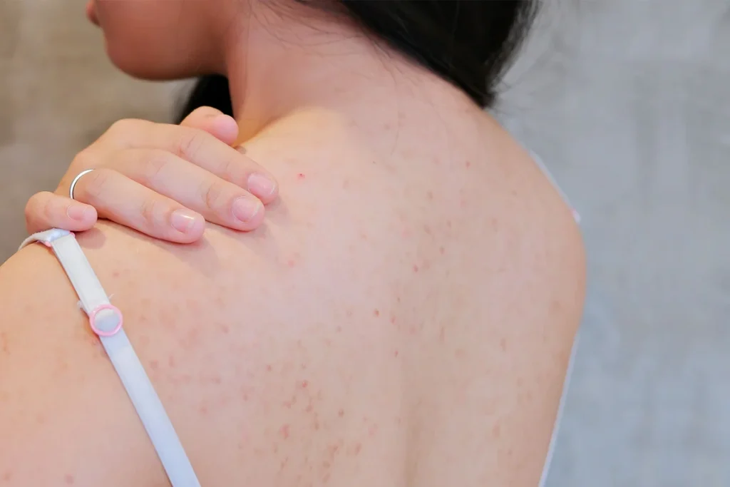 Understand the causes of back acne and learn effective treatment and prevention tips to achieve clearer, healthier skin.