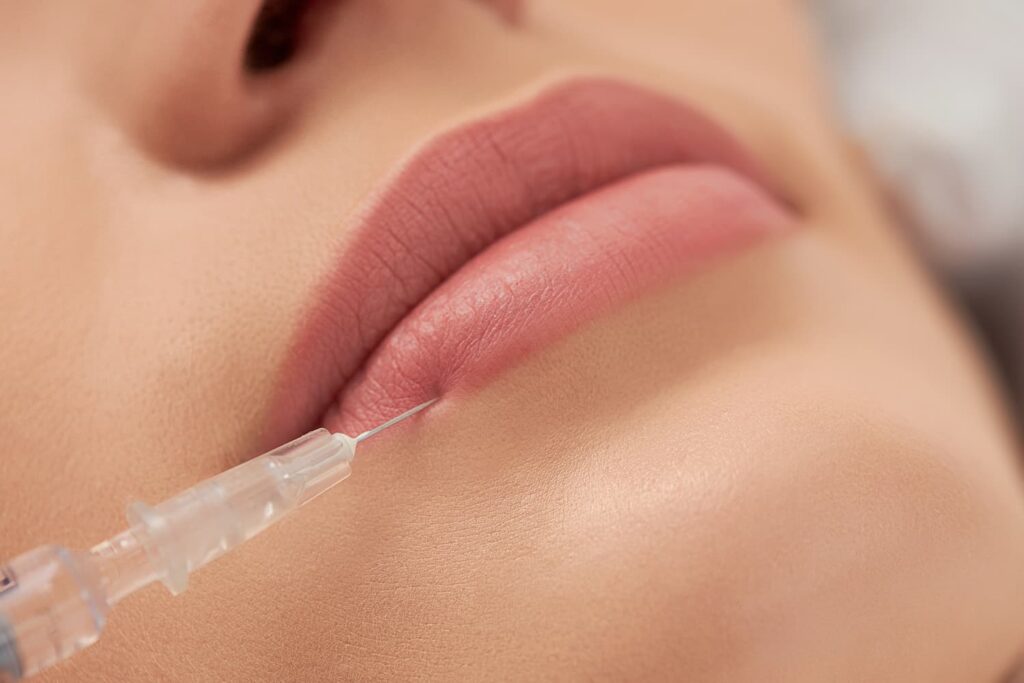 Lip Fillers in Dubai