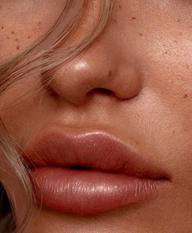 Dermal Fillers Dubai - Roxana Aesthetics Clinic