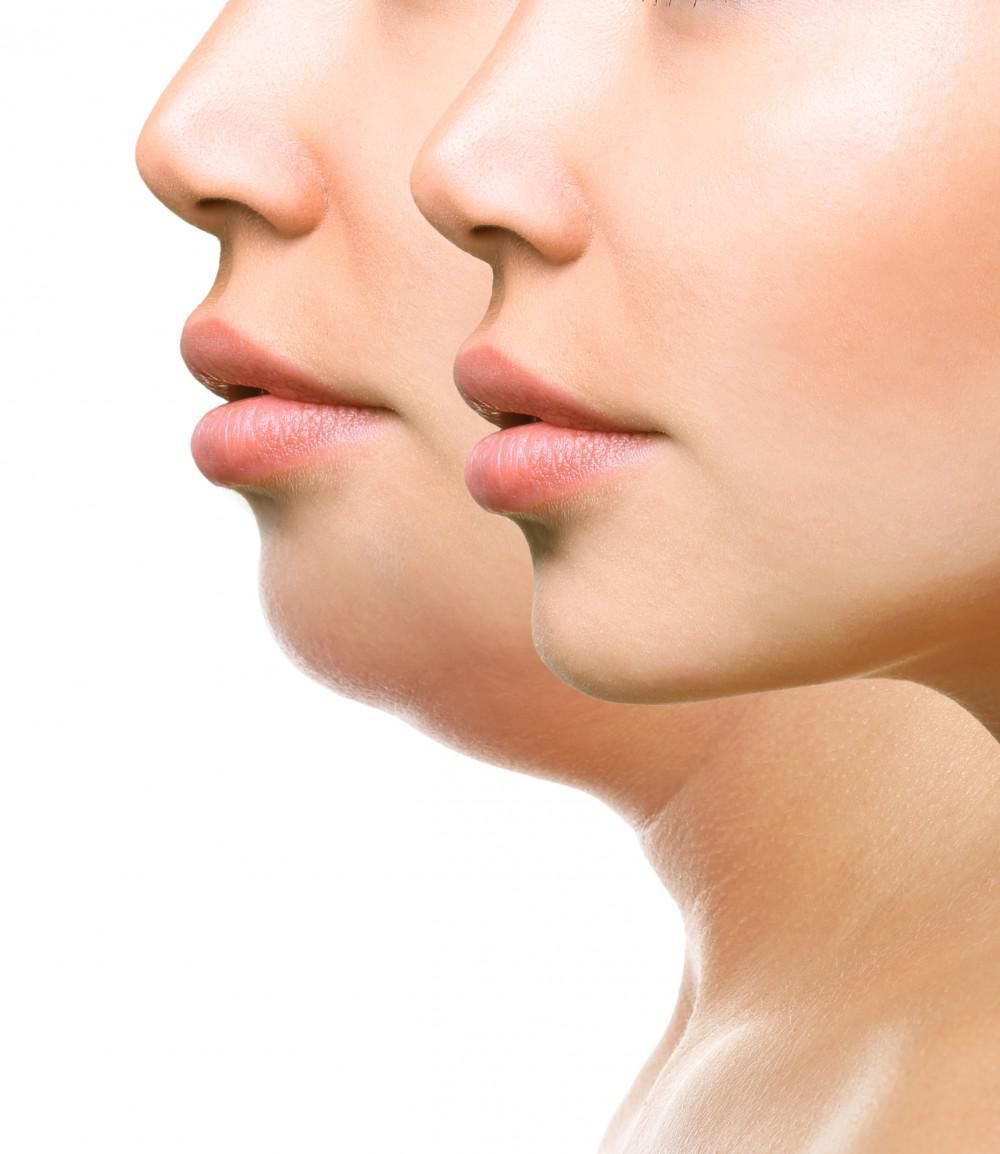 Double Chin Reduction - Roxana Aesthetics Clinic