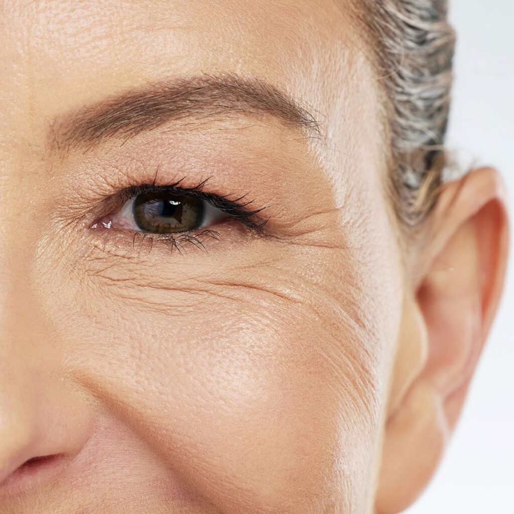 Wrinkle Treatment Dubai - Roxana Aesthetics Clinic