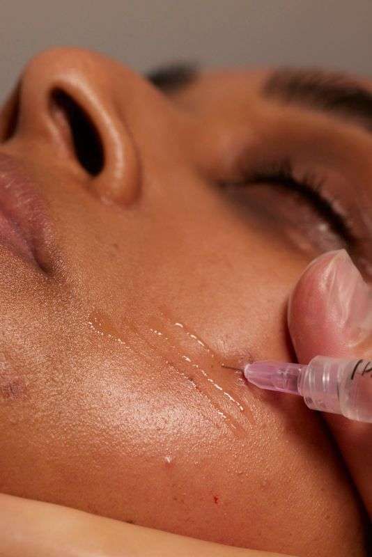collagen stimulating injections - Roxana Aesthetics Clinic