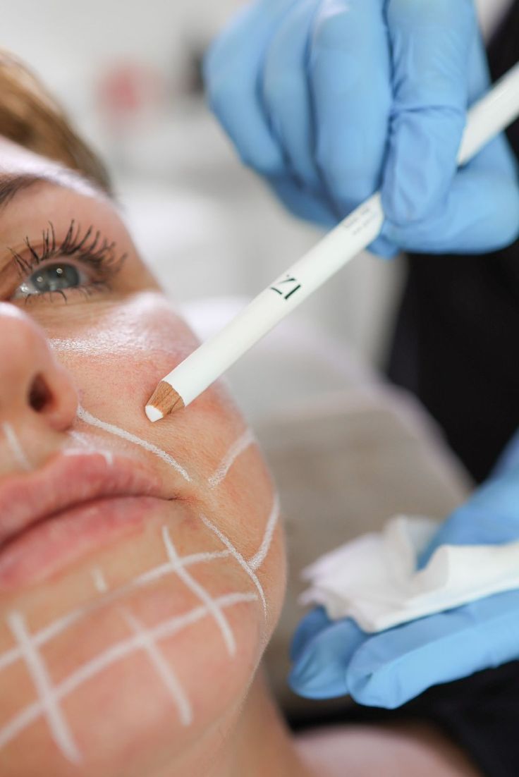 Sculptra vs Radiesse - Roxana Aesthetics Clinic