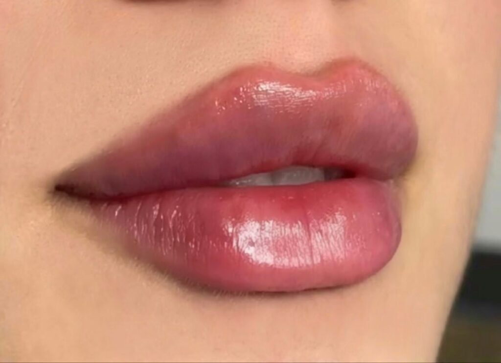 Russian vs classic lip filler - Roxana Aesthetics Clinic
