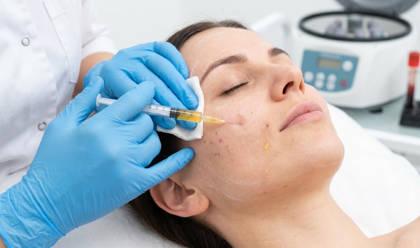 PRP therapy for skin - Roxana Aesthetics Clinic