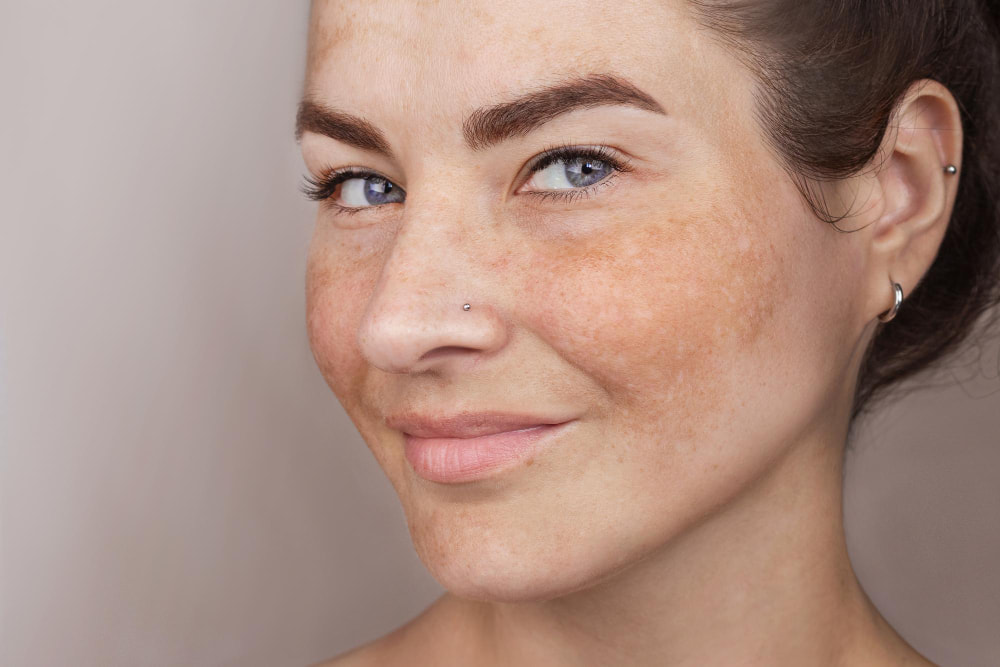 Girl with hyperpigmentation treatment - Roxana Aesthetics Clinic