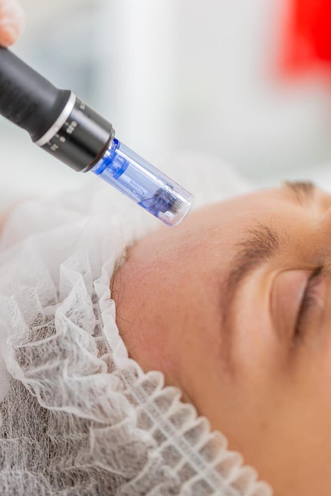 Microneedling in Dubai