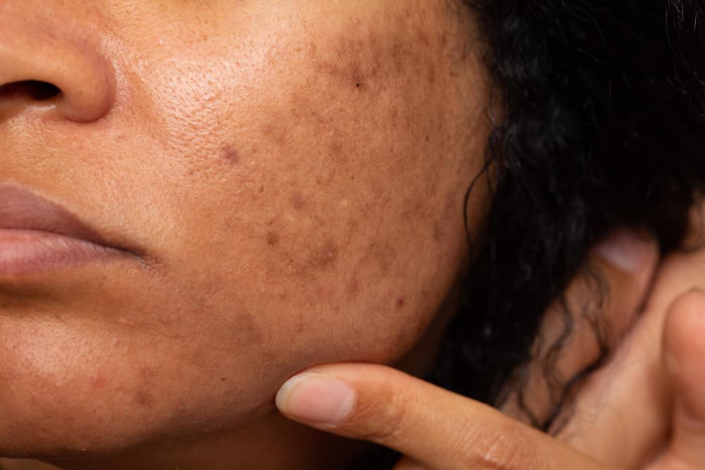 hyperpigmentation treatment Dubai - Roxana Aesthetics Clinic